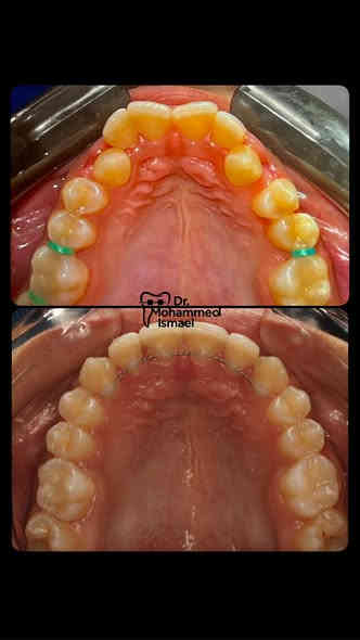 يسرنا اعلامكم بتواجد
الدكتور محمد اسماعيل المشهداني
اخصائي تقويم الاسنان
نقدم لكم خدمات تقويم الاسنان المعدني والشفاف وزراعة الاسنان (بأحدث الانظمة وبالتقسيط )
،
حشوات تجميلية، حشوات جذور، وقلع جراحي

العنوان: الخالدية-شارع عشرين- مجمع الطائف الطبي
للحجز والاستفسار: 
يمكنكم التواصل عبر الواتساب او الاتصال على الرقم:👇
                          📞 ***********
،

لمشاهدة الحالات التي تم علاجها زورونا على صفحة العيادة
https://www.facebook.com/share/1Do88FgLBa/?mibextid=wwXIfr
،
(كتب الله لكم السلامة والعافية من كل مرض)
