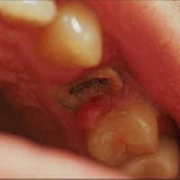 مرحبا الي عندة جذور متبقيه او كسر باسنانه الاماميه يتفضل بعيادات جامعة...