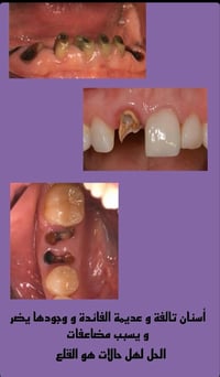 وجود مثل هيج جذور تالفة قد يسبب: ( علاج مجانا بكامل) 🌹🌹  1- التهابات م...