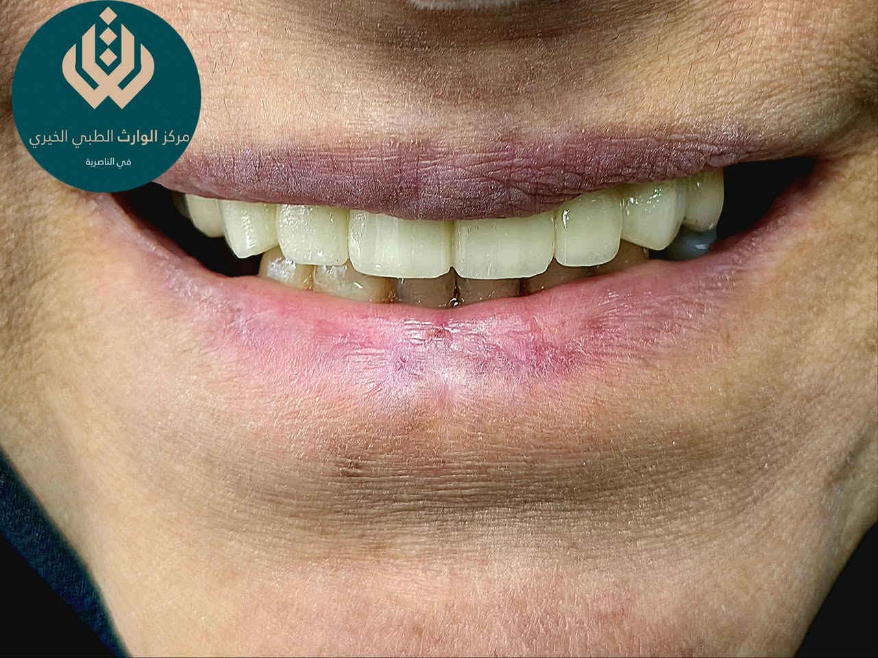 بين الدقة الطبية واللمسة المبدعة في مركز الوارث وُلدت هذه الابتسامة  هادئة في بريقها عميقة في أثرها ومصممة لتليق بك وحدك.
من اعمال طبيبنا المتميز 🫡
د ثائر عباس

📍 متواجدين يومياً طول أيام الأسبوع:
⏰ من الـ9 الصبح للـ12 الظهر
⏰ ومن الـ2:30 العصر للـ9:30 بالليل

📞 للتواصل ويانه:
✅ العيادات البشرية: ‎***********
✅ عيادات التجميل: ‎***********
✅ عيادات الأسنان: ‎***********

📍 العنوان: الناصرية – شارع بغداد، مجاور مدرسة الجواهري الأهلية
