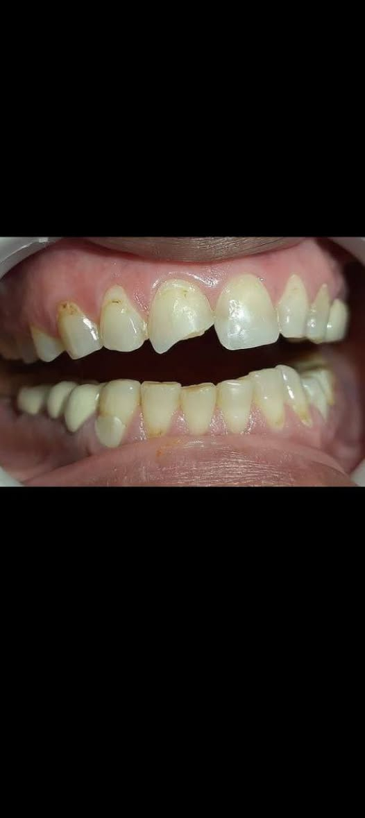 السلام عليكم اللي محتاج حشوة مجانية وعندة مثل هاي الحالات يتواصل واتساب ***********  جامعة الهادي نهاية شارع 60 قرب كنيسة بولص وبطرس
