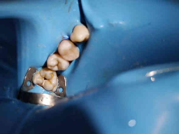 عمل حشوة جذر مع إعادة بناء...
العنوان(مسيب_تقاطع مسيب كربلاء_مجاور اعدادية السجاد)
للحجز والاستفسار 
***********
