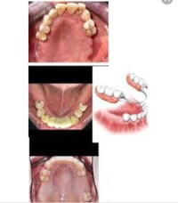 مجانا • تعويض الاسنان • عيادات جامعة الكوفة