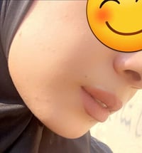 خلطة ايرانية • قبل وبعد • صابونه وسيروم