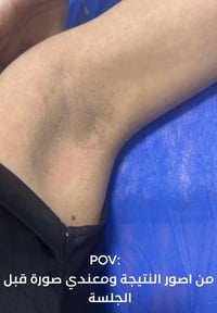 ليزر الابط • جهاز كانديلا • العبيدي