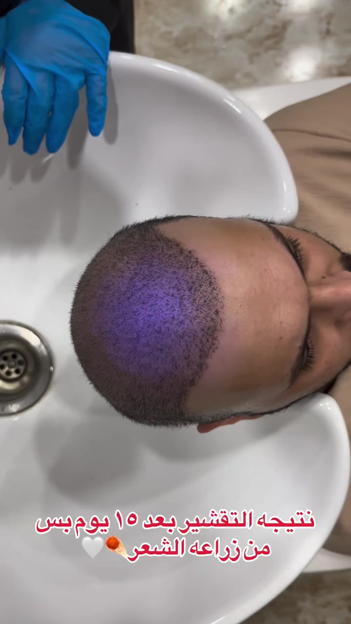 بعد ١٥ يوم بس من زراعة الشعر
مرحلة التقشير  تخلص ☑️
والفروة تبدي تتنفس☑️
والنتيجة تبين نظيفة وطبيعية 👌

هاي مو نهاية الرحلة… هاي البداية الصح لكثافة أقوى وشعر يرجعلك ثقتك خطوة خطوة

كل هذا بفضل خبرة الكادر الطبي 
وتقنيات مدروسة
 تضمن أفضل بداية لرحلة كثافة صحية وطبيعية ترجعلك ثقتك بنفسك🫵🏻🩶

للحجز والاستفسار 
***********
 او زورونا بموقع العياده 🟦 بغداد المنصور شارع الرواد مقابل مرطبات مشمشه
