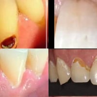 اي شخص  عنده هيج تسوس باسنانه يراسلني07750577772 العلاج مجاني