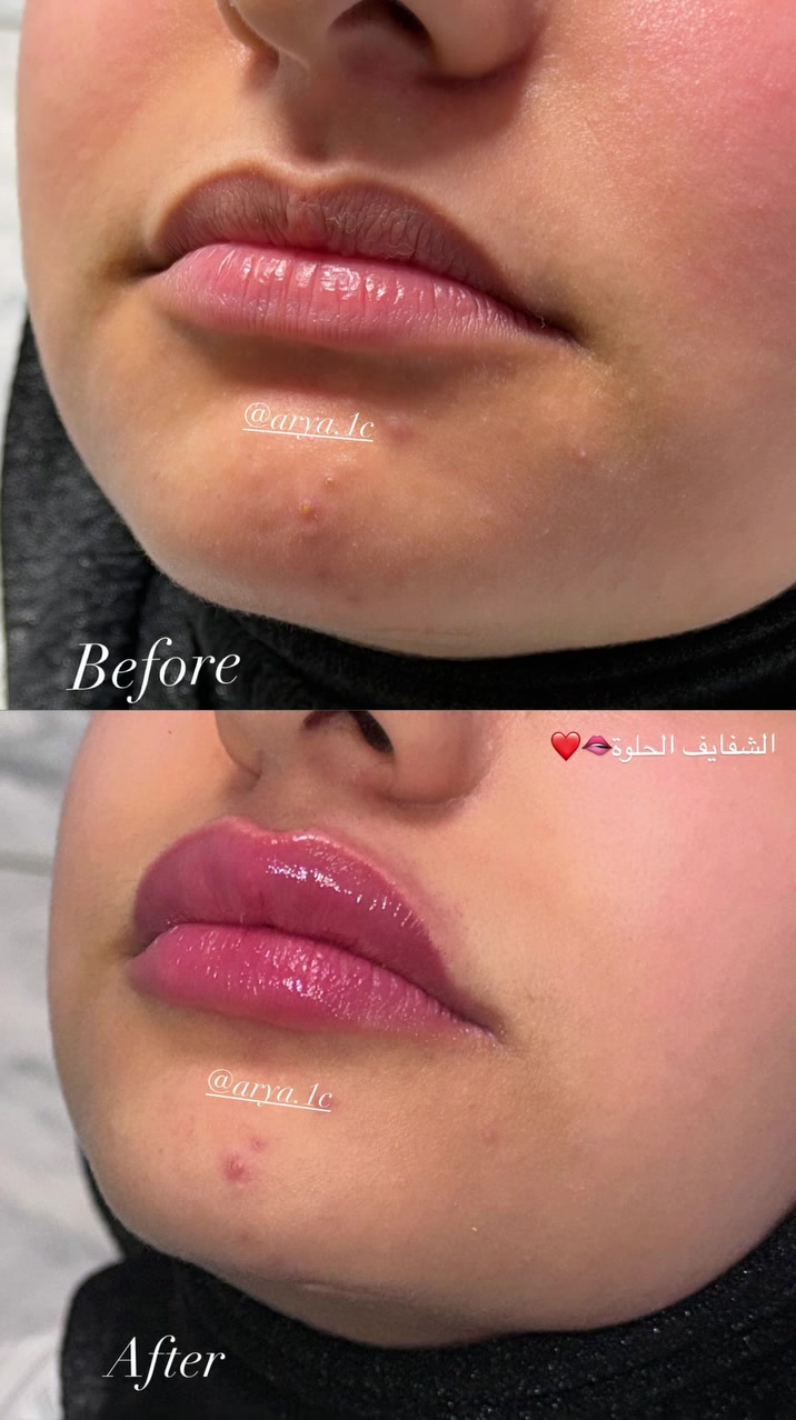 اريا للتجميل فلر شفه 1cc
للتواصل ***********
