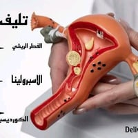 تليف الرحم • أورام ليفية • علاج تليف الرحم • علاج طبيعي للرحم • الفطر ...