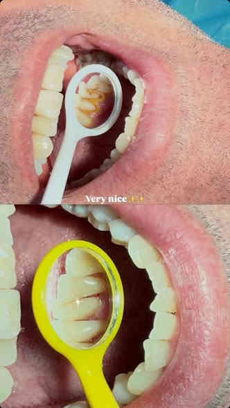 📣السلام عليكم 
الي محتاج تنظيف لاسنانه موعد العيادة باچر ساعه 12:00 كرادة شارع 52  للتواصل واتساب ***********
🔺العلاج مجاناااً
