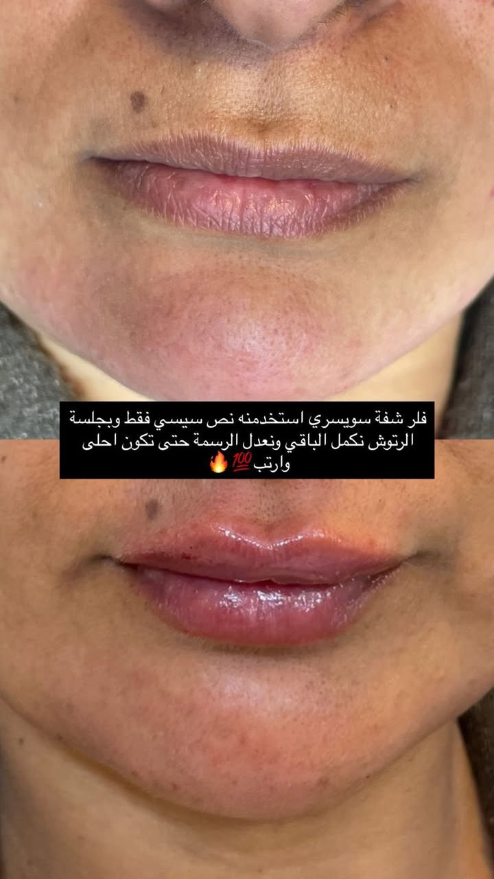 زيركون بسماية لطب الاسنان والتجميل
كلشي متوفر بالنقد وبالتقسيط بدون مقدمة للموظفين والمتقاعدين 

عرض العيد الكل ينتظرة سارعو الحجز
- فلر كوري+بلازمة مفعلة  100 
- فلر بلجيكي+بلازمة مفعلة 125
ومتوفر فلر سويسري و ايطالي براند
- تذويب فلر فوري — ٣٥ ألف
- ⁠بوتوكس باودر لكل الوجه 125
- ⁠ميزو هالات وتصبغات ومكس تفتيح 75
- ⁠بلازمة مفعلة+بي ار بي للتساقط 50
- ⁠ابر نظارة براند بجميع انواعها 

الحقن يتم بيد طبيبات الاختصاص الدكتورة زهراء نجاح وباستخدام مواد أصلية مفحوصة من وزارة الصحة لضمان نتيجة آمنة وجميلة 💎
———————————————————
—العنوان بغداد-مقابل مجمع بسماية السكني-السايد الراجع من بغداد-على الخدمي .
  للحجز+اسفسار ***********زيركون بسماية
