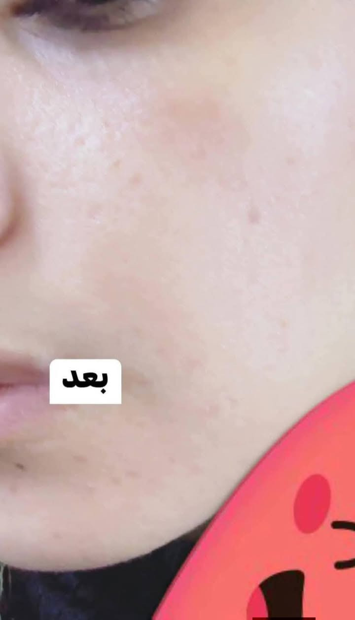 قبل العيد اذا مو يصير بشرتكم كزازه خلطه والله لايتقبل صيامي وصلاتي اذا فلوسكم ماترجع الباب بيكم ضمان اطي ١٠ ايام  ادخلو ع صفحتي وشوفو شغلي وتجارب  كولها شغل ادينه  مابيها اي مواد ضر ابد اقوا كلف زيله نمش تصبغات اثار حب شباب تبيض البشره صفيها ترطبها  هسه تكرلون ليش تحلفين احلف للمداقيه لان بيجات ماخلت  صار ٥ سنوات اشتغل بيها تموت للوجه اول يوم تحسون فررق. يعني خلطه واحد ع كرل البيجات اتحداهم بيها سعر خاص@إشارة
للمتابعة


**إذا كنت صاحب هذا الإعلان وتريد حذفه لأي سبب، رجاءا أرسل رسالة إلى الدعم الفني**