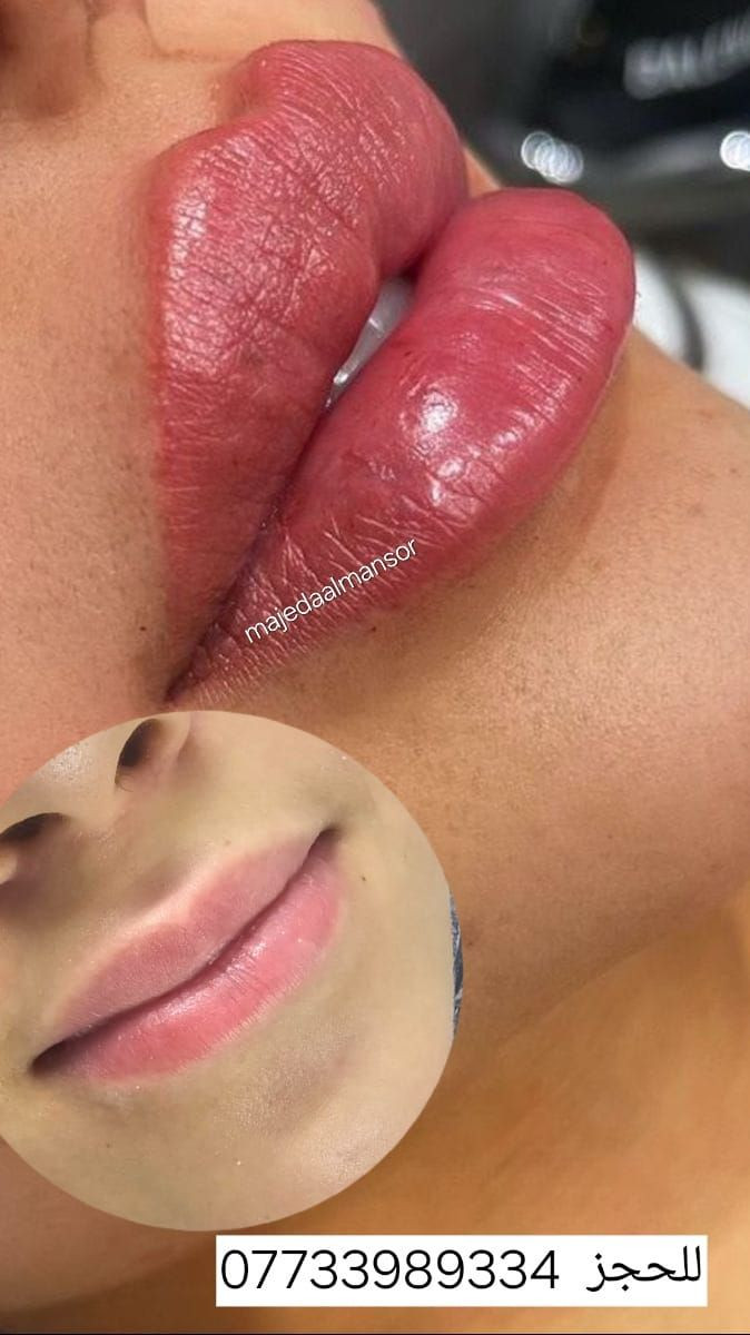شفايف ممتلئة وطبيعية تخلي جمالج يبين من أول نظرة 💋
فيلر الشفاه عندنا بلمسة ناعمة ونتيجة تفتح النفس ✨
  الدكتورة ماجدة المنصور Jojo Alnabeel 
العنوان بغداد الحسينية مقابل السوق الكبير مجاور مرطبات العذراء
مجمع سما الحسينيه للطابق الثاني قسم التجميل والصالون ***********
