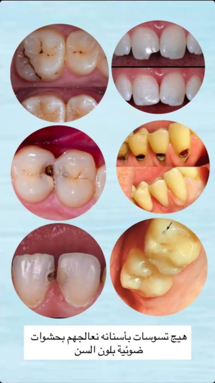 قلع مجاني ✨️✨️
قلع مجاني ✨️✨️
العنوان جامعة المنارة قرب مستشفى الصدر 
للإستفسار دايركت 
نستقبل اغلب الحالات 
بقايا الجذور والأسنان المتحركة


**إذا كنت صاحب هذا الإعلان وتريد حذفه لأي سبب، رجاءا أرسل رسالة إلى الدعم الفني**
