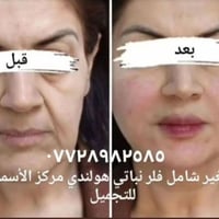 مساء الخير فلر شفه ٣٥ ذقن ٣٥ صدغ ٣٥ وجنات ١٠٠ خطوط ضاحكه ٣٥ تغير شامل ...