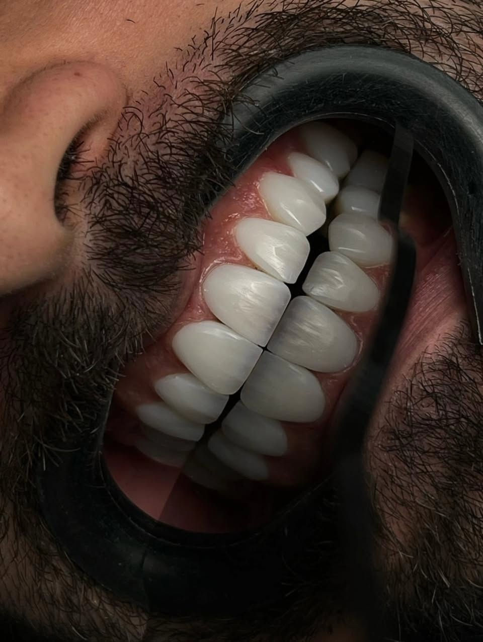 "🦷 أسنان صحية وابتسامة مشرقة...

في مراكز الشركة الطبية العالمية ، نوفر لك أحدث تقنيات طب الأسنان، وأسهل طرق الدفع.

✅ تقويم الأسنان ✅ تبييض الأسنان ✅ ابتسامة هوليوود
زراعة أسنان 
وحشوات وكتير من الخدمات 

متواجدين داخل المركز طيلة أيام الأسبوع لخدمتكم 

  #عيادة_اسنان #طب_اسنان #كي_كارد #KeeCard #دفع_الكتروني تقويم_اسنان تبييض_الاسنان زراعة_الاسنان ابتسامة جمال صحة

العنوان : طويريج _الشارع العام_مجاور نقابة المعلمين _مقابل المكتبة العامة _مجمع الحارث الطابق الثاني 

رقم الهاتف ***********
                ***********

