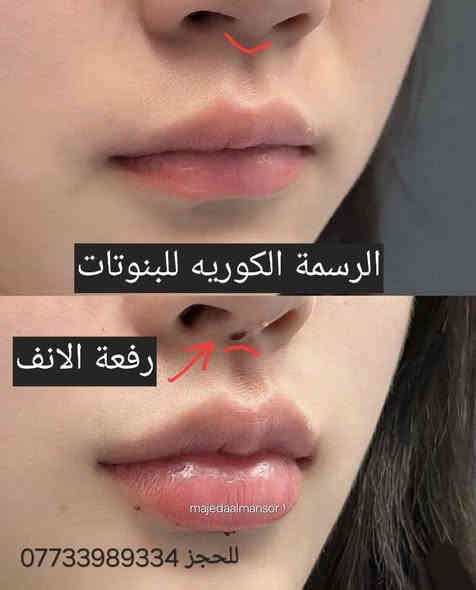 طبيعي – مظهر أنثوي جذاب
💉 جلسات فيلر شفايف بمواد أصلية وآمنة
✔️ تكبير الشفايف بشكل متناسق
✔️ تحديد الحدود بلمسة أنيقة  الدكتورة ماجدة المنصور Jojo Alnabeel
العنوان بغداد الحسينية مقابل السوق الكبير مجاور مرطبات العذراء
مجمع سما الحسينيه للحجز ***********  حساب التيك توك 
https://www.tiktok.com/@ma8j4?_r=1&_t=ZS-915uhyehfWy
