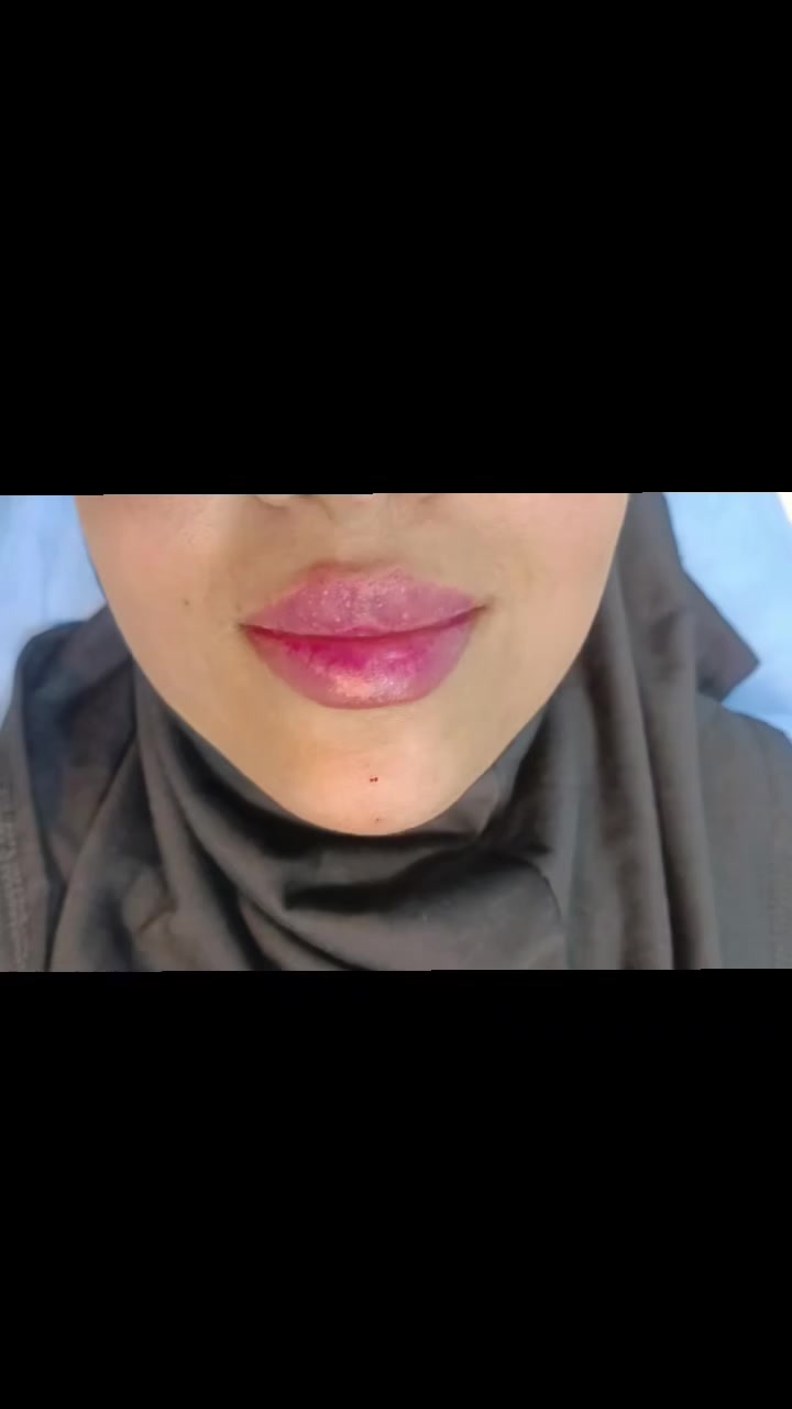 التناسق و دقه الرسم كلها نحجي بلفيديو
0776 874 7627 
#فلر
#بوتوكس
#تجميل
