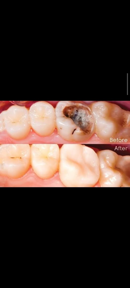 علاج مجاني
السلام عليكم ورحمة الله وبركاته للمرضى الاعزاء يتوفر لدينا :-

قلع سن.

 حشوة اعتيادية.

 تنظيف الاسنان من التكلسات.

تبديل حشوة قديمة بحشوة ضوئية.

طقم اسنان للفكين الاسفل و الاعلى.

مجاني في  عيادات جامعة النور التخصصية لطب الاسنان بإشراف الدكاترة المتخصصين في طب الاسنان الاستفسارات والأسئلة العامة الاتصال على الرقم التالي :
***********
الدكتور واثق عبدالله حسن 
ابتسم وانت مرتاح
