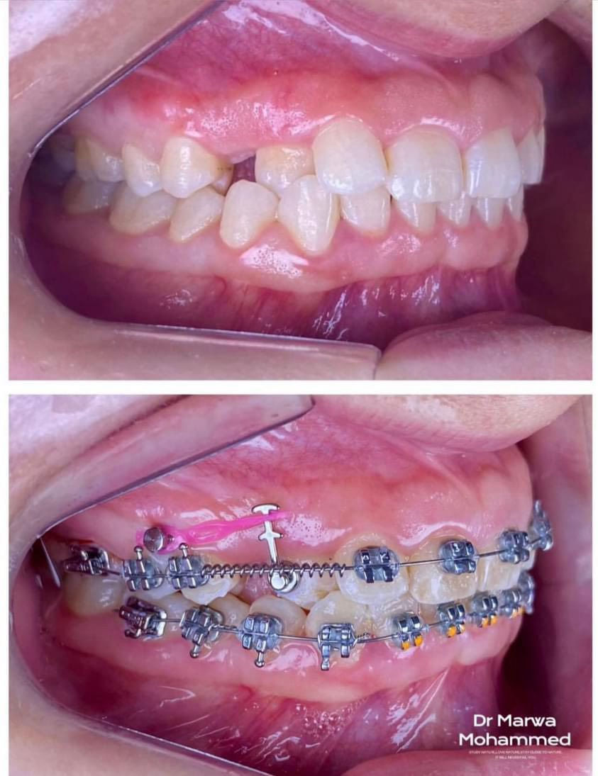 تقويم الأسنان 
د. مروة محمد طالب 
للتواصل ع الرقم
***********
