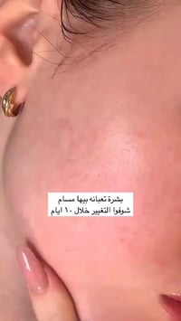 سيروم سنتيلا • تفتيح وترطيب • مناسب لحب الشباب