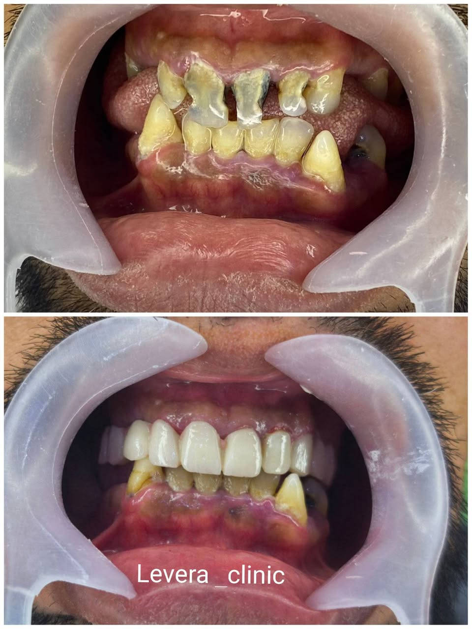 عيادة ليڤيرا لطب وتجميل الاسنان 
   نستقبلكم يوميا من الساعة 3 مساءً إلى 8 مساءٌ 
  أبتسامات عالية الجودة ضمان بالعمل 
    متابعة دورية بعد الانتهاء من العمل 

للحجز والاستفسار ***********
   أو زورو العيادة 
العنوان الناصرية-حي أريدو شارع مستشفى القلب مجاور الصيدلية النموذجية 

#أبتسامات #تركيب_اسنان #عيادةاسنان #حي_أريدو #الناصرية #أبتسامة_دايركت_فينيير #أبتسامة_هووليود
