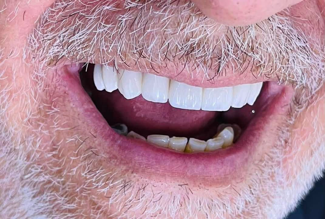 ابتسامه جديده لمراجعنا 🦷

تعويض الأسنان المفقوده وتركيب أسنان الزاركون الثابته 
اعادت للمريض الأبتسامه الطبيعيه ووظيفه المضغ 

ابتسامه صحيه  ومتناسقه 🔥🔥

‎العنوان : قلعة سكر - شارع الاطباء - بجانب صيدلية النبراس (مجمع الكواظمة / الطابق الثاني)
‎للحجز والأستفسار 📞 ***********
‎او مراسلة الصفحة
