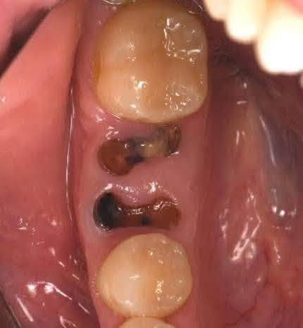 📍🦷📍
نعالج في عيادات جامعةالهادي 

- قلع الاسنان والجذور التالفة
- تنظيف الاسنان من التصبغات والتكلسات
- حشوات تجميلية للاطفال والكبار 
- تعويض الاسنان بطقم كامل متحرك 

ان كنت تعاني من احد هذه المشاكل☝🏼يمكنك التواصل معي عن طريق المراسلة في الخاص او الرقم ***********
-الموقع الدورة نهاية شارع ستين -(قرب كنيسةبولص وبطرس) قرب 

(علماً ان العلاج مجاني بشكل كامل وبأشراف اطباء مختصين)
