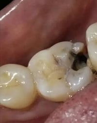 حشوة ضوئية • مجانا • شارع ٤٠