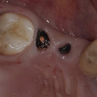 قلع مجاني • جذور تالفة • عيادات جامعة الفراهيدي