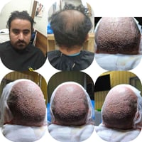 عملية إعادة زراعة شعر فاشله❌  نقوم بإصلاح ما أفسده الآخرون🚫  مو كل فشل...