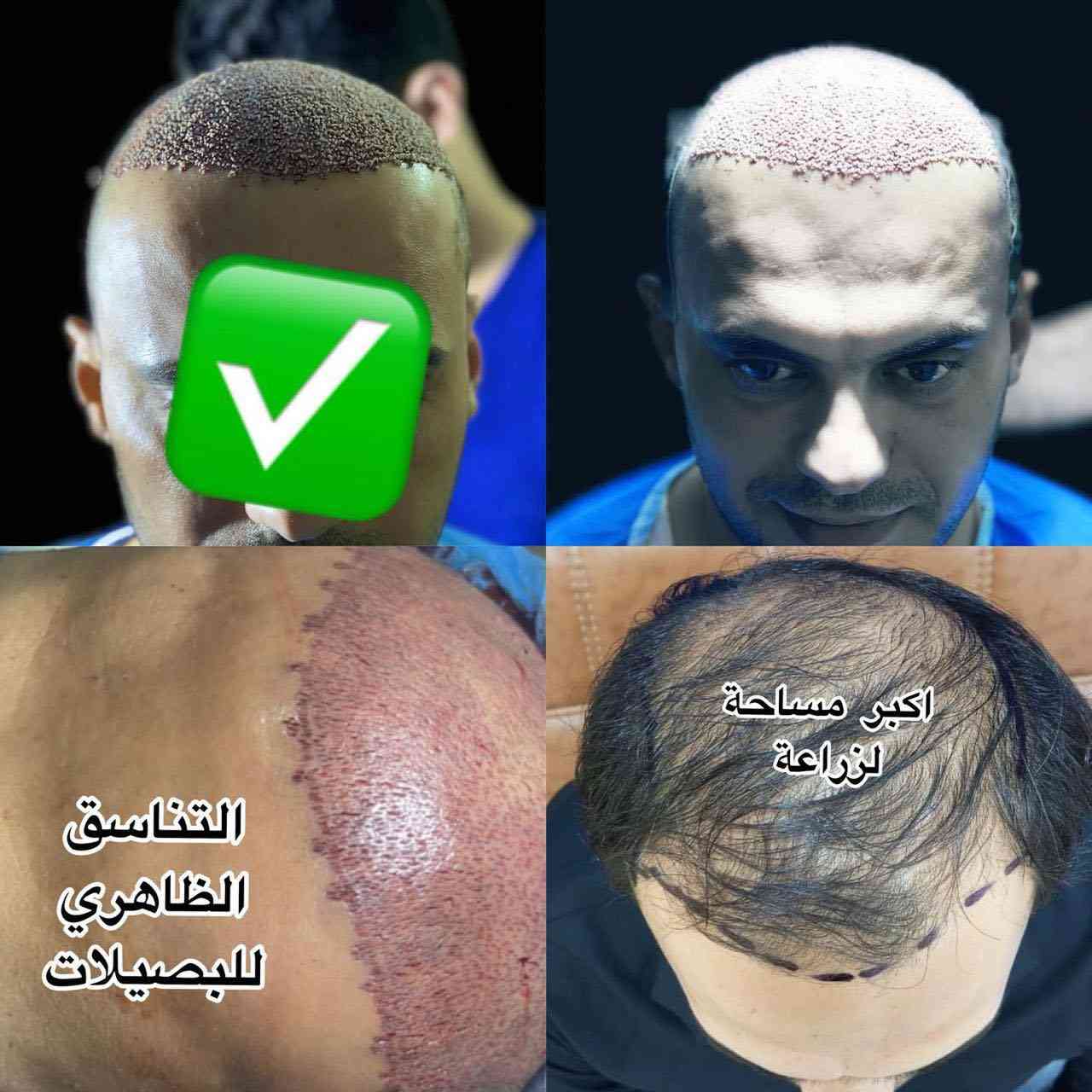 ملاحظة مهمّة جدًا 👇
قبل لا ينسرق الكلام من قبل المراكز
ويبدون يحچون بنفس الطريقة ونفس الصيغة

مركز المتخصص
هو المركز الوحيد
اللي يشرح كافة التفاصيل
قبل الزراعة وبعد الزراعة 🫵🔥👌

انتبه زين
قبل لا تتخذ القرار النهائي 👇

⸻

خطة زراعة الشعر مضمونة
على يد الطبيب المختص
شغل دقيق
يقلّل نسبة الخطأ إلى أدنى حد

المركز يتحمّل مسؤولية أي خطأ
أمّا نجاح العملية
فيعتمد على خبرة المختص
الذي يقوم بقطف البصيلات
بدقّة عالية جدًا

كما تعتمد النتيجة على
غرز البصيلات في المكان الصحيح
بعد فتح القنوات
بزاوية واتجاه صحيحين
وبما يتوافق مع اتجاه الشعر القديم

وتعتمد مرونة ومظهر الشعر
على عمق فتح القنوات
وبقياسات هندسية دقيقة
مدروسة بعناية
من قبل المختص

⸻

VIP اختيارك المفضّل

📞 واتساب للحجز:
***********

📞 الإدارة (واتساب):
***********

📞 واتساب للحجز:
***********
