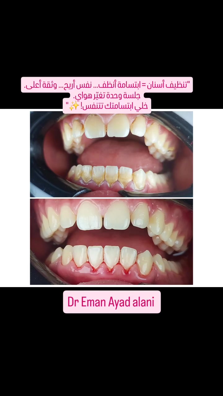 "تنظيف أسنان = ابتسامة أنظف… نفس أريح… وثقة أعلى.
جلسة وحدة تغيّر هواي.
خلي ابتسامتك تتنفس! ✨"

دكتورة ايمان اياد العاني 
الرمادي-شارع المستودع-عمارة الحاسبات-قرب مرطبات زنبقة
للحجز والاستفسار مراسلة الصفحة او الاتصال بالرقم ***********
فيس Dr Eman Ayad alani 
انستا @dremanayadalani 
#تنظيف_اسنان #تنظيف_الأسنان_و_اللثة #تجميل_اسنان #البنج_الالكتروني #جهاز_البنج_الالكتروني #الم_اقل_راحة_اكثر #الرمادي_شارع_المستودع #عيادة_اسنان
