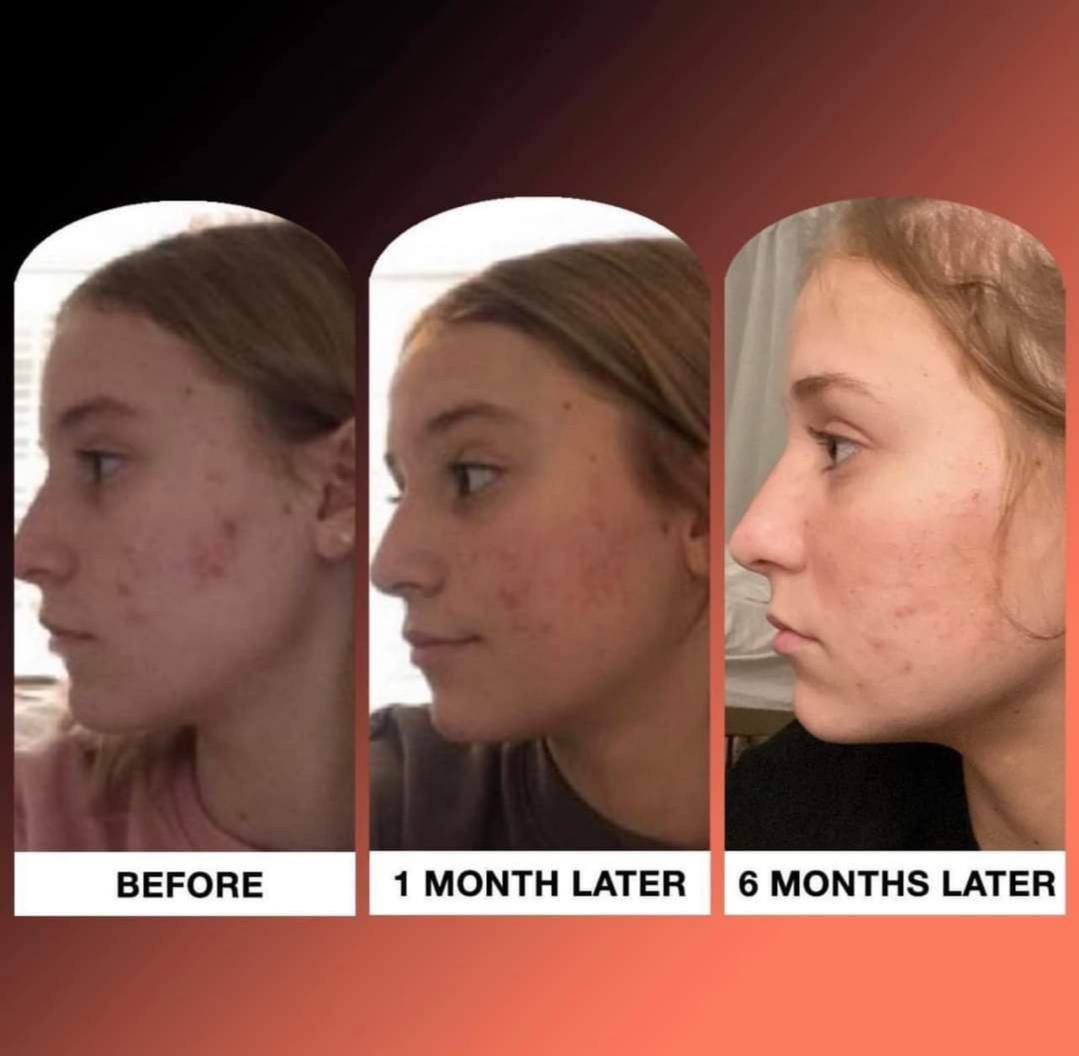 ‏PanoXyl acne foaming wash🦋💧الامريكي🇺🇸 الاصلي💯 

غسول بانوكسيل رغوي متعدد الاستخدامات وازالة حب الشباب وارثاره من الوجه والصدر والضهر وتصفية البشرة والجسم من بانوكسيل من مادة البنزويل بيروكسايد 10%

غسول بانوكسل الوجه الرغوي ماكسيموم سترينث لحب الشباب للوجه والجسم والمناطق الحساسه 
من بانوكسيل يحتوي على 10% بنزويل بيروكسيد
✅ غسول رغوي فائق القوة. 
يخترق المسام بفعالية ويقتل البكتيريا التي تسبب حب الشباب
✅ يزيل عيوب حب الشباب الموجودة ويمنع ظهور عيوب جديدة
✅ أعلى قوة من بيروكسيد البنزويل المتاحة بدون وصفة طبية
✅ يزيل الأوساخ والزيوت الزائدة بلطف لتنظيف المسام وفكها. مما يجعله خيارًا ممتازًا للتحكم في حب الشباب على الوجه والصدر والظهر.
✅ يحتوي علي بينزويل بيروكسايد 10‎%‎ يعمل علي ازالة حب الشباب ويساعد علي عدم ظهورها 
✅ خال من العطور والبارابين وميزته يحتوي علي مرطب يعني 
ميسبب جفاف للبشرة

للسعر:: 12الف

توصيل لجميع المحافظات 🇮🇶:: 4.


**إذا كنت صاحب هذا الإعلان وتريد حذفه لأي سبب، رجاءا أرسل رسالة إلى الدعم الفني**
