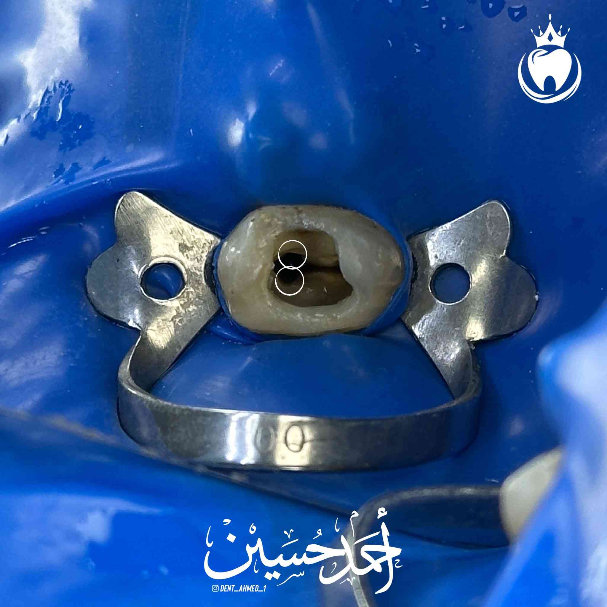 زارنا مراجع عنده ألم بسنه بعد الفحص و الاشعة تبين وجود مشكلة في حشوة الجذر لهذا السن 
حيث تم اعادة حشوة جذر المعمولة بشكل خاطئ لسن ضاحك علوي🦷 
مع وجود التهاب تحت الجذر  نتيجة عدم تحشية كافة قنوات السن 
واستبدال الحشوة المعدنية ب حشوة ضوئية و استعادة وظيفة و شكل السن الطبيعي الشرح تحت الصور  

الدكتور احمد حسين الطعماوي 
المكان : ناحية الزاب -المجمع الطبي الحديث مجاور مرطبات كرزة
للحجز و الاستفسار : ***********
