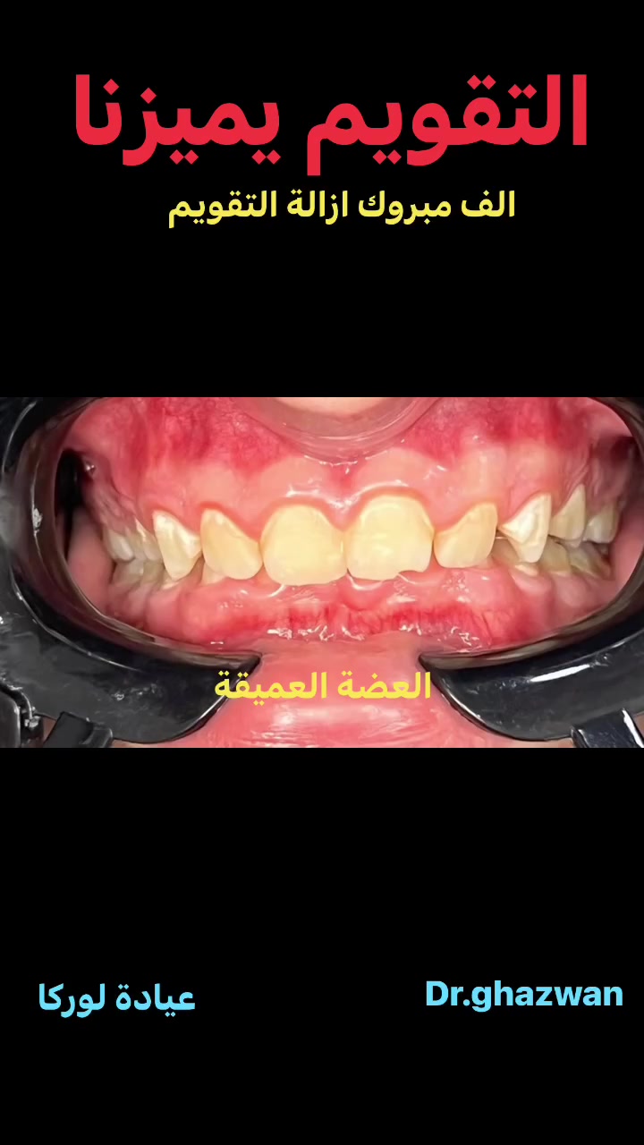 التقويم يميزنا احد اعقد و اصعب الحالات الحمدلله تم ازالة التقويم يعاني من العضة العميقة و عض سقف الفم اثناء تناول الطعام و الكلام و عض الشفة السفلية كذلك  …. نتائج مضمونة أسليب علمية ضمن نتائج مزيلة لجميع المشاكل و السلبيات دكتور غزوان مزهر بغداد الكرخ نفق الشرطة بداية شارع الاطباء  فوق صيدلية كنز النفق متوفر واتس ***********  #تقويم_الاسنان #تقويم_الشفاف_للأسنان #تقويم_الأسنان_بأنواعه #زراعة_الاسنان #العضة_المعكوسة #تقدم_الفك_السفلي  #العضة_المفتوحة @تقدم_الفك_السفلي  @تقويم_الاسنان

