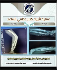 كسر الساعد • تثبيت بالصفيحة • جلولاء