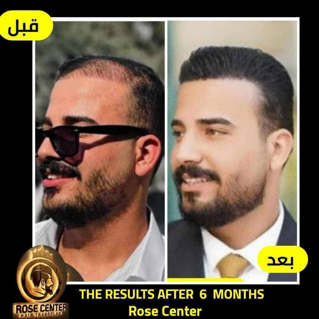 معكم الاستشارية طبيه يسر
تحب تزرع لا تحتار كلينك روز اقدم وارقي مركز بغداد كثافة وشكل مميز مرتب مع شهادة ضمان

واني اسويلك معاينه مضبوطة واتابع حالتك طول فترة الزراعة 🩵🌷

فقط اتصل

***********

متوفر واتساب 👆
