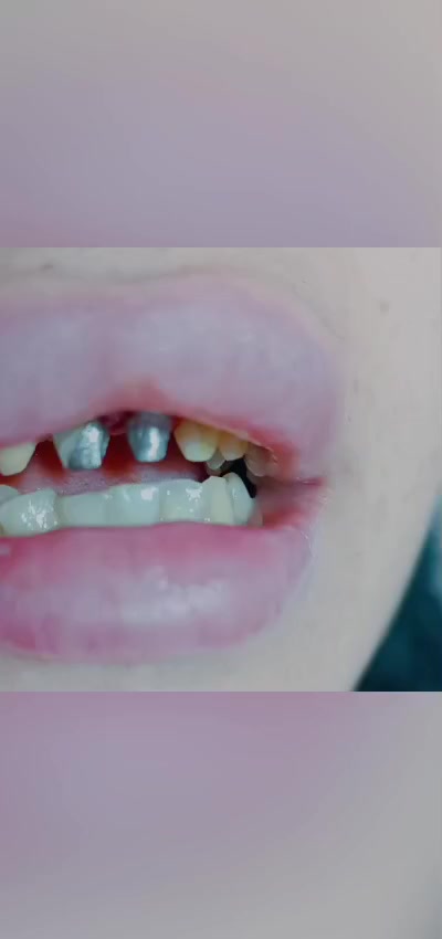 أُجريت إحدى المعالجات التجميلية للمرضى في مستشفى المؤيد الأهلي 3 – فرع الصويرة على يد #الدكتور_حسين_مخلوف (أخصائي طب الأسنان وجراحتها) حيث تكللت العملية بالنجاح بفضل خبرته المهنية وكفاءته العالية وباستخدام أحدث الأجهزة والتقنيات الطبية في مجال طب الأسنان التجميلي

للاستفسار و الاتصال 
*********** / ***********
