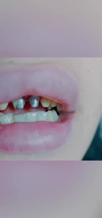 تجميل أسنان • مستشفى المؤيد الأهلي • الدكتور حسين مخلوف