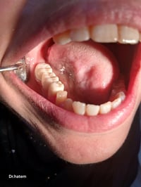 عيد مبارك سارع للحجز عروض عيد الفطر تركيبات زيركون سيراميك  عيادة السل...