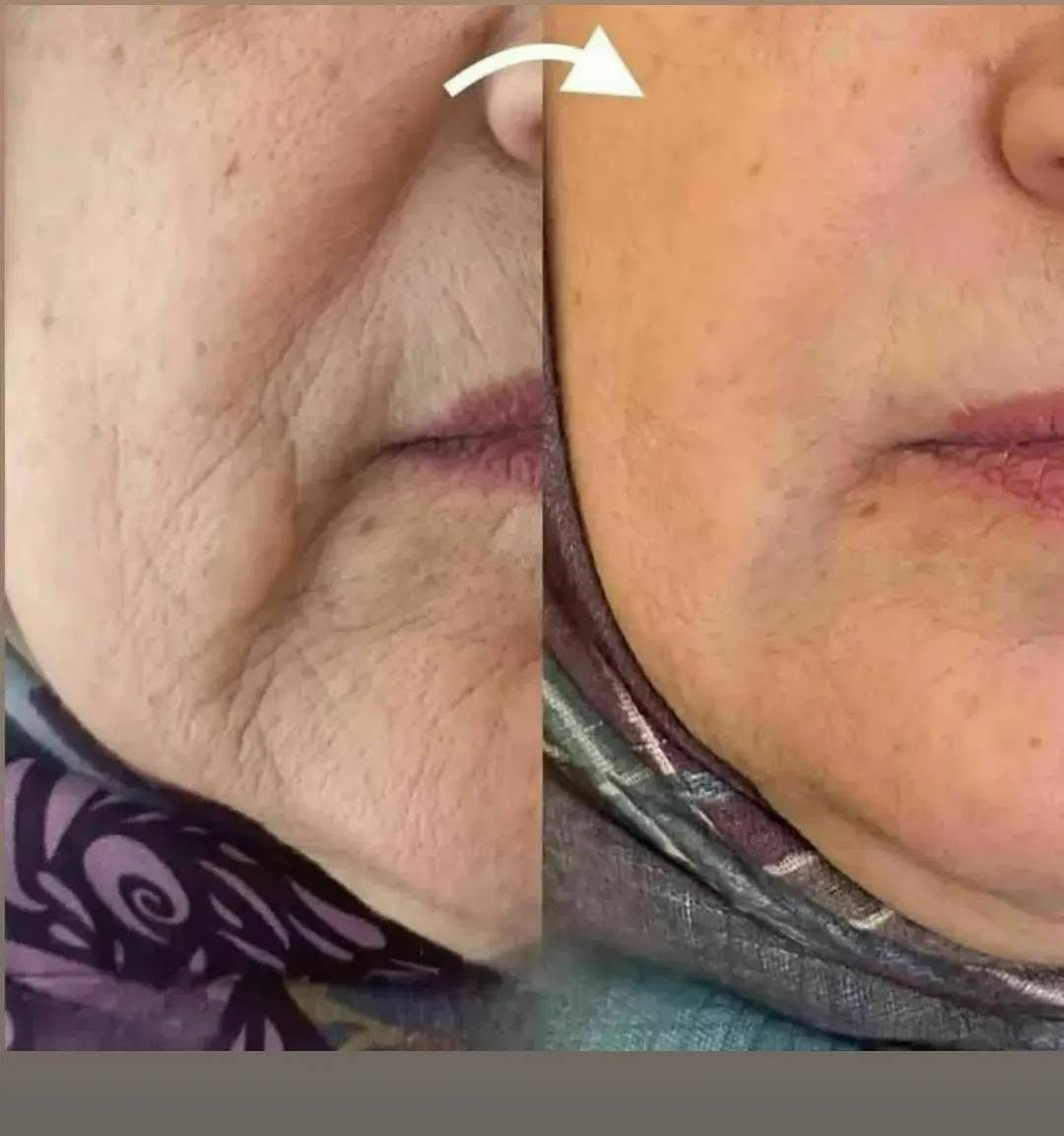 نتيجه احد زباين  كان عمر زبونه 45@ سیروم جل لیدوراکر مضاد للتجاعيد لبشرة الوجه، يحتوي على تركيبات فعّالة تُساهم في تقوية البنية الجلدية وزيادة مرونة البشرة. هذا السیروم جل يُحفّز إنتاج الكولاجين والإيلاستين، مما يجعل البشرة أكثر تماسكاً، شباباً وانتعاشاً. الإستخدام المنتظم لهذا السیروم جل لا يُحسّن مظهر البشرة فحسب، بل يساعد أيضاً في منع ترهّلها و إرتخائها.

 الميزات :
الوقاية من الشيخوخة المبكرة للبشرة، إزالة التجاعيد والخطوط الرفیعة، مضاد أكسدة قويه للغاية، شدّ البشرة، تقليل البقع الجلدية


**إذا كنت صاحب هذا الإعلان وتريد حذفه لأي سبب، رجاءا أرسل رسالة إلى الدعم الفني**