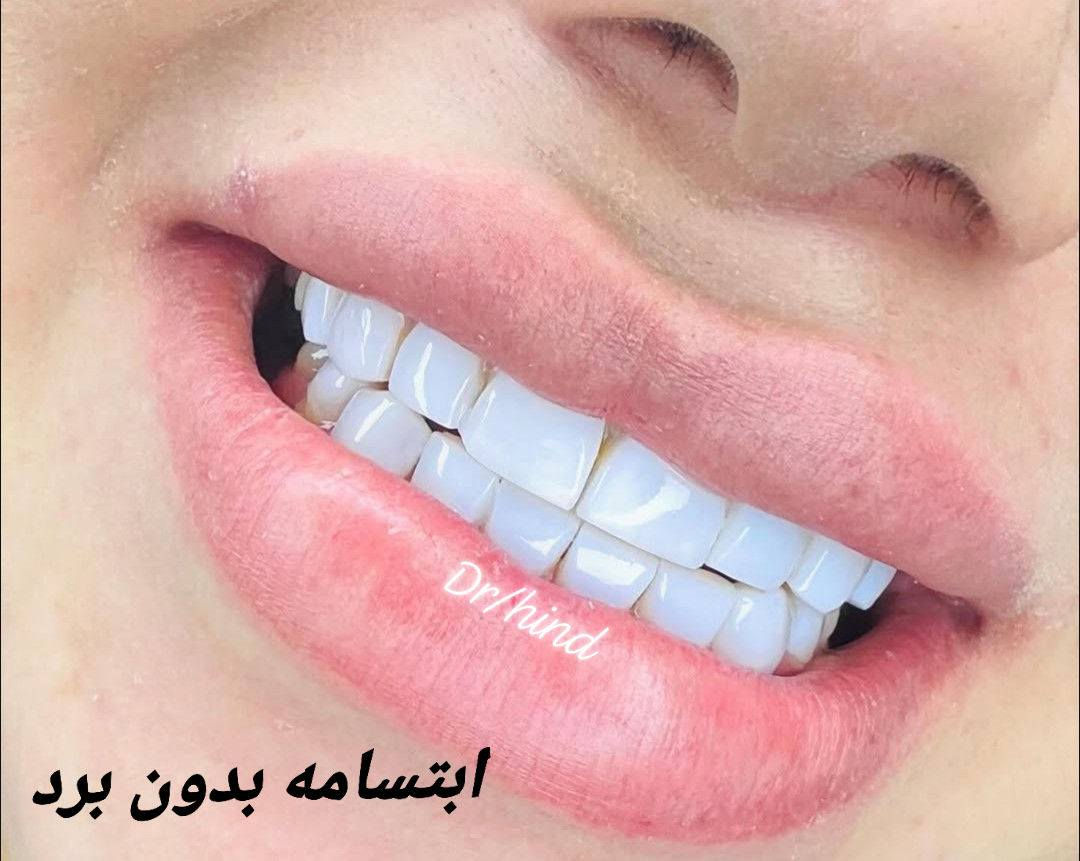 ✨ عروض العيد لتعديل الابتسامة ✨
عيادة دكتوره الدكتورة هند الحسيني 
خلي ابتسامتكم أحلى بهالعيد 😍🦷
🎀 تبييض الأسنان بالليزر
🎀 سد الفراغات بالحشوات التجميلية
🎀 تنظيف وتلميع الأسنان
🎀 ابتسامة دايركت فينير بدون برد
ابتسامة مرتبة وطبيعية من أول جلسة ✨
📩 للحجز والاستفسار مراسلة خاص
او على الرقم ***********
📍الحجز مسبق والأماكن محدودة
@إشارة
