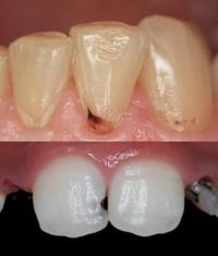 علاج اسنان مجاني • تسوس • كربلاء حي النقيب