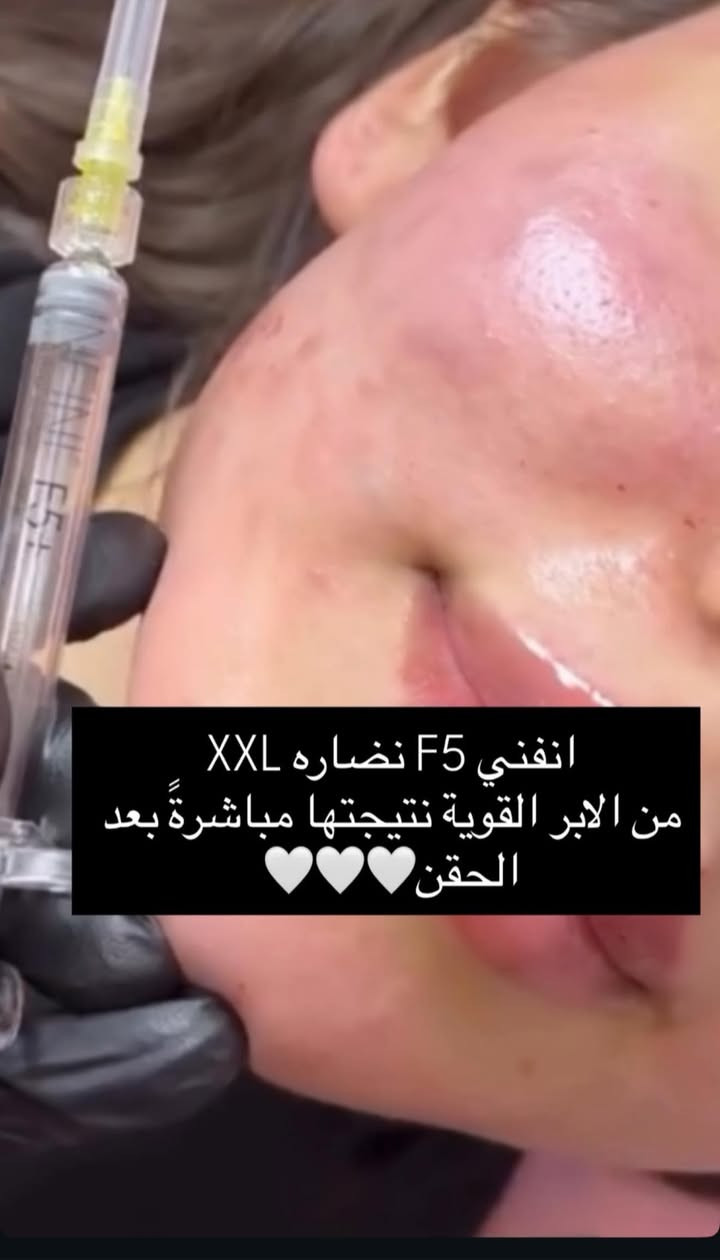 شغل طبيبتنا المبدعة د رسل متواجد جميع الايام
النظام الحجز ضروري قبل يومين على الاقل 

جميع الاجراءات التجميلية بوتوكس فلر نضاره وعلاج تصبغات وتساقط الشعر 
متوفر داخل عيادتنا وحاليا اكو عروض بمناسبة عيد الحب للاستفسار عن العروض التواصل على الواتساب ***********
