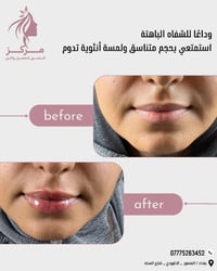 ودّعي الشفايف الباهتة 💋 واستمتعي بحجم متناسق ولمسة أنثوية طبيعية تدوم ...