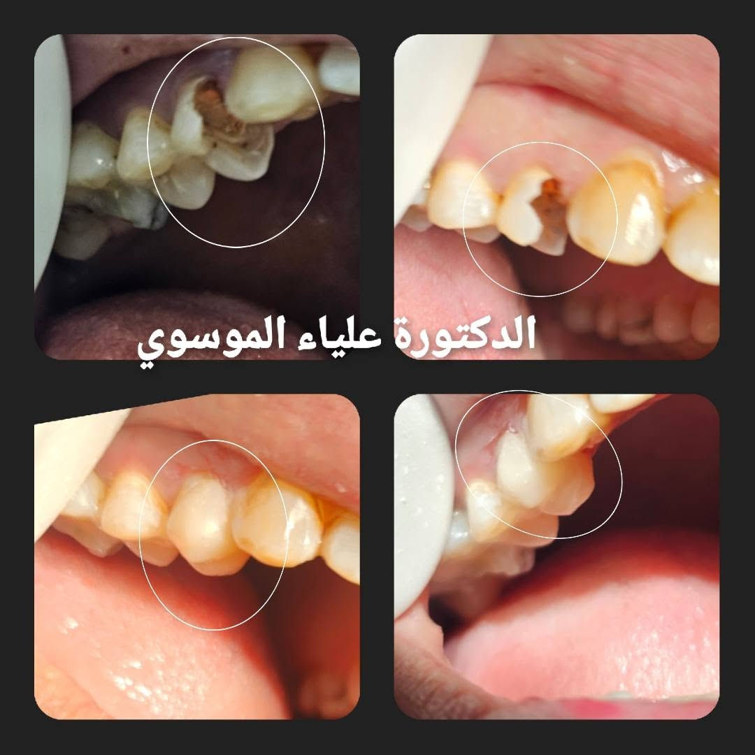 تتواجد الدكتورة علياء الموسوي يوميا من ساعة ٤ إلى ساعة ٩ مساءا في المشتل شارع المطبك للاستفسار ***********
