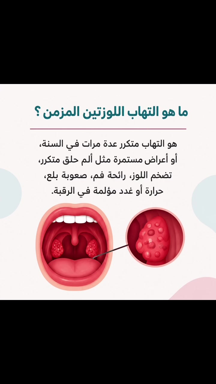 التهاب اللوزتين المزمن عند الأطفال

د.ياسر الزيادي
إختصاص طب الأطفال وحديثي الولادة
بغداد / رحمانية الشعلة / مقابل عمارة الوليد / قرب صيدلية الوسام 
للحجز ***********

 #التهاب_اللوزتين  #صحة_الطفل  #دياسرالزيادي
