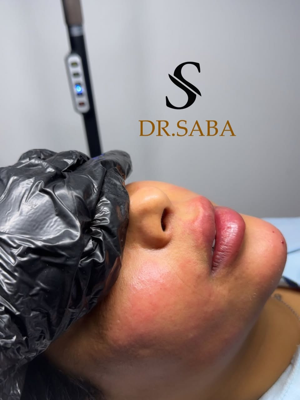 تكنيك الوجه كامل بأيدي للجميلة روح ع اخر صورة وشوفو القبل♥️🫶🏻

فلر شفة + ذقن + استدارة بسيطة
#فلر #فلرشفة_فلر_وجنات_فلرخطوط_ضاحكة_فلرذقن_تكساس_تكنيك❤️❤️❤️ #فلر_بوتكس #فلر_شفايف👄


**إذا كنت صاحب هذا الإعلان وتريد حذفه لأي سبب، رجاءا أرسل رسالة إلى الدعم الفني**