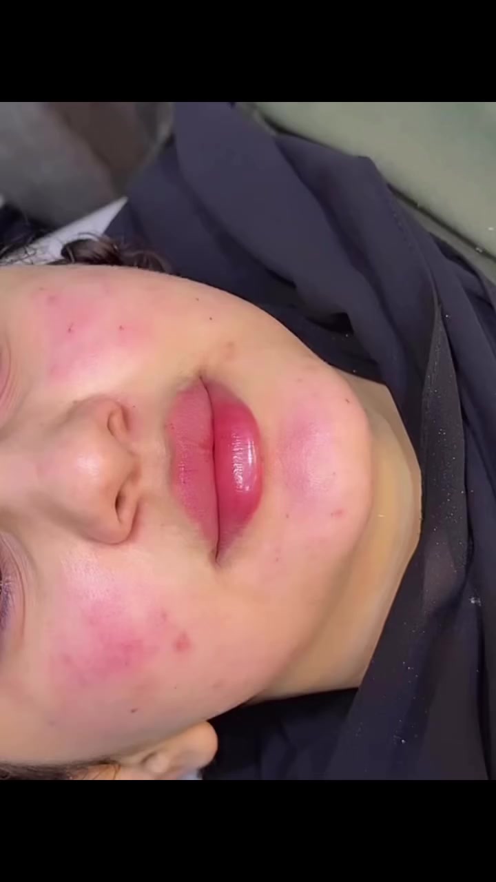 فرصتكِ الأخيرة قبل العيد ❤️‍🔥

فلر الشفة📣 مع بلازما وفيتامينات للشفة والوجه بسعر 50 الف فقط 🤩

التغير الشامل📣
فلر اصداغ + فلر وجنات +فلر شفة مع إبراز للذقن + ابرة بلازما مُفعلة كل هذا بسعر 250 ألف فقط 🤩

للحجز راسلونا خاص 😍
 
📍 العنوان: بغداد – المدائن  – شارع الأطباء – مقابل صيدلية أبو أثير المشهداني

#عروض_العيد #نيو_لوك #فلر #نضارة #عيادة_الدكتورة_إيلاف


**إذا كنت صاحب هذا الإعلان وتريد حذفه لأي سبب، رجاءا أرسل رسالة إلى الدعم الفني**